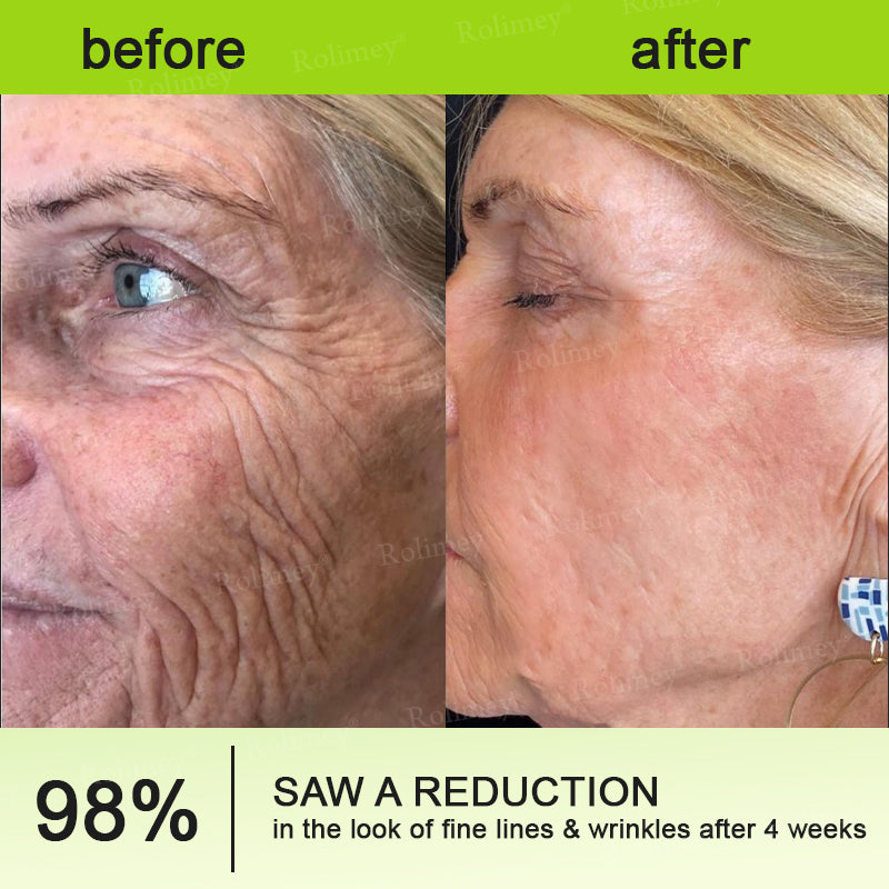 ☘️✨Made and shipped from the USA 💫Rolimey® Botox & Vita-A Retinol Shot Wrinkle-Lift Tightening cream - Last Day Promotion 70% OFF