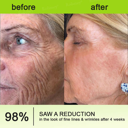 ☘️✨Made and shipped from the USA 💫Rolimey® Botox & Vita-A Retinol Shot Wrinkle-Lift Tightening cream - Last Day Promotion 70% OFF