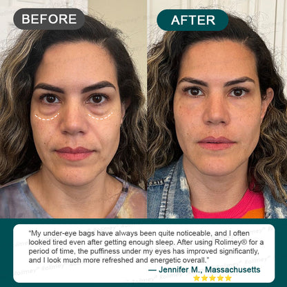 ✅USA HOT SALES ✨Rolimey® Botox & Stem Cell Wrinkle-Lift Tightening Cream
