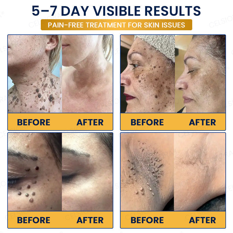 🙌🌿✨GFOUK® 7-Day MicroNeedle Wart & Skin Tag Removal Patch