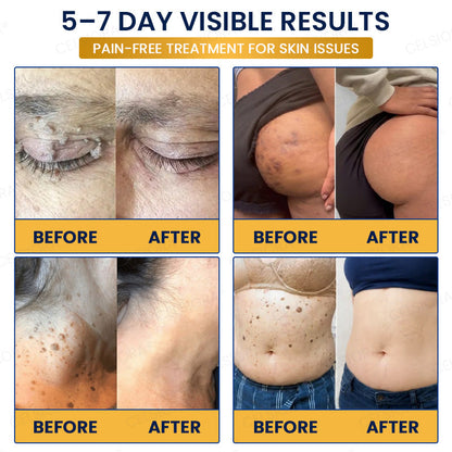 🙌🌿✨GFOUK® 7-Day MicroNeedle Wart & Skin Tag Removal Patch