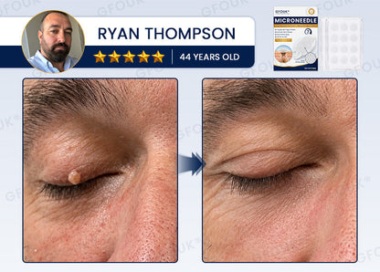 🙌🌿✨GFOUK® 7-Day MicroNeedle Wart & Skin Tag Removal Patch