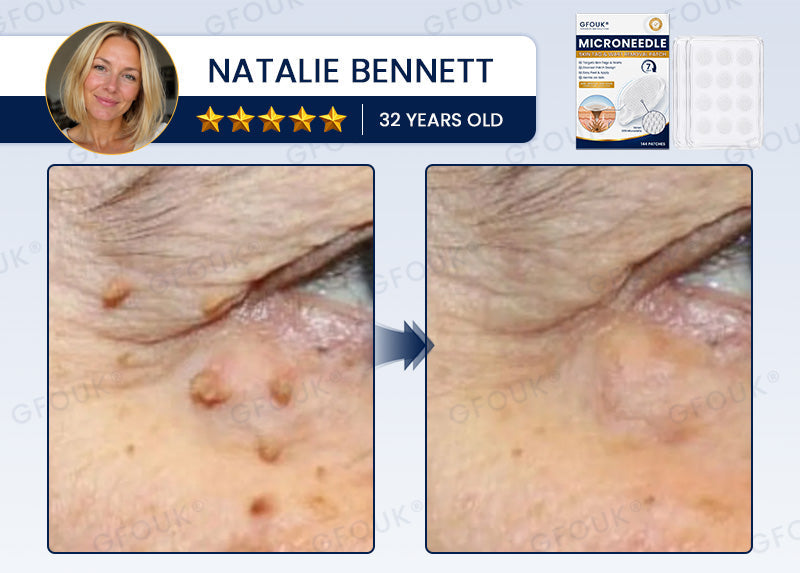 🙌🌿✨GFOUK® 7-Day MicroNeedle Wart & Skin Tag Removal Patch